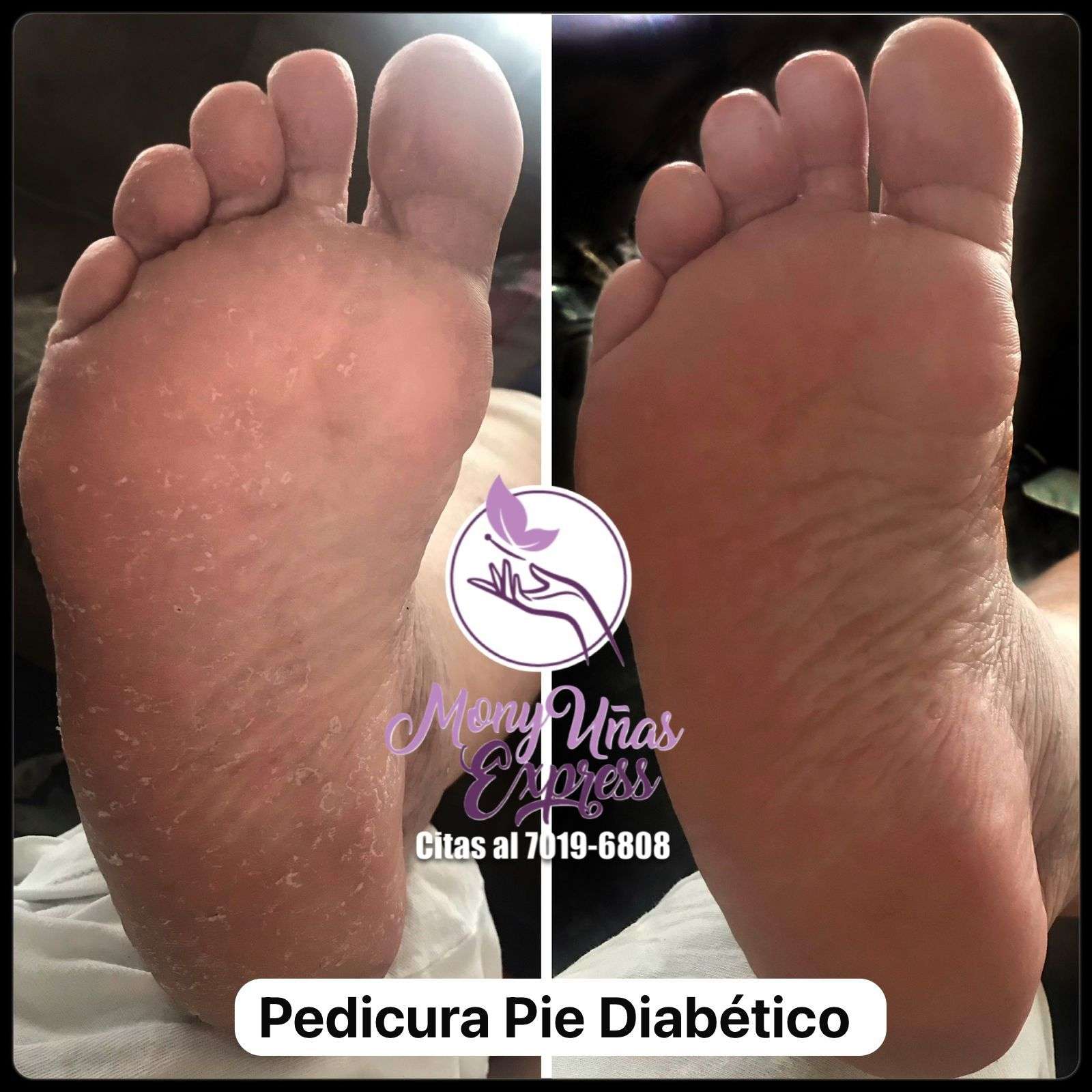 Pedicura Pie Diabético