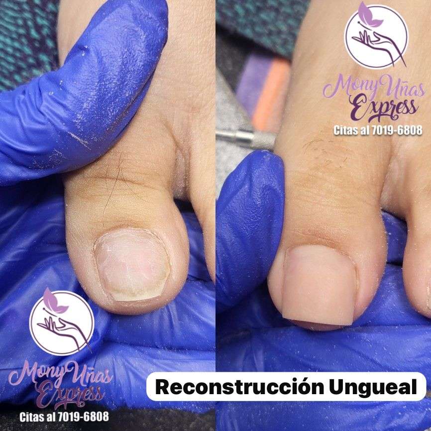 Reconstrucción Ungueal